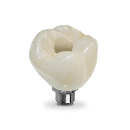 Screw-Retained Crown